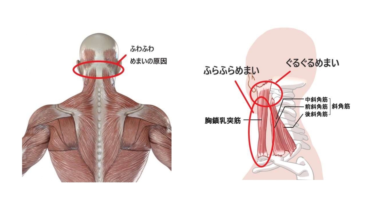 めまいの根本原因は首コリです