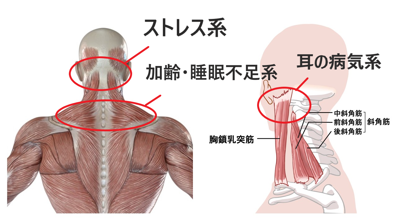 耳鳴りの根本原因は首コリです