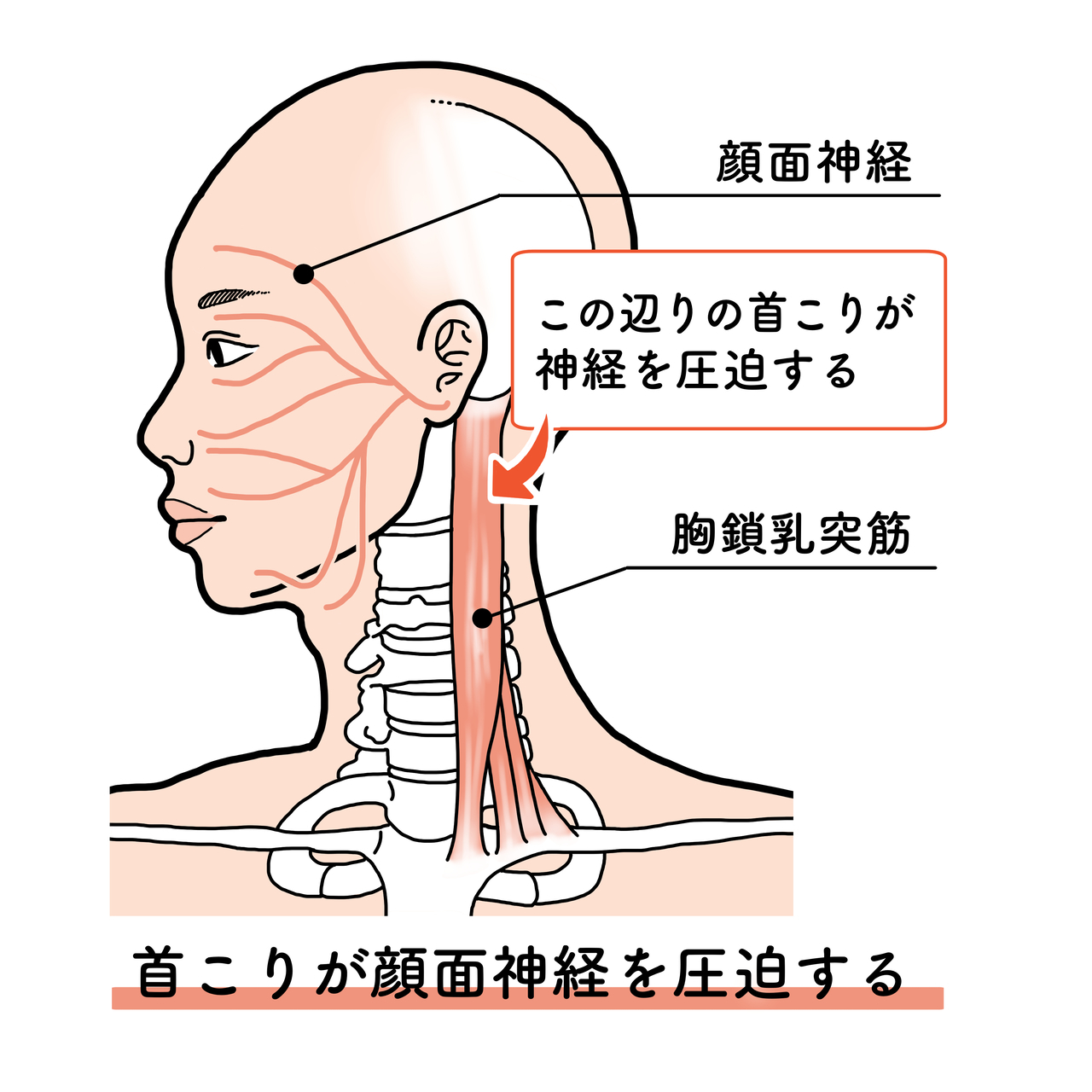 顔面神経麻痺の原因は首コリ
