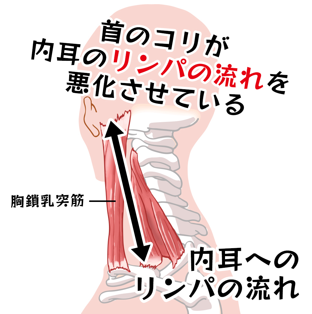 メニエール病の本当の原因は首コリです