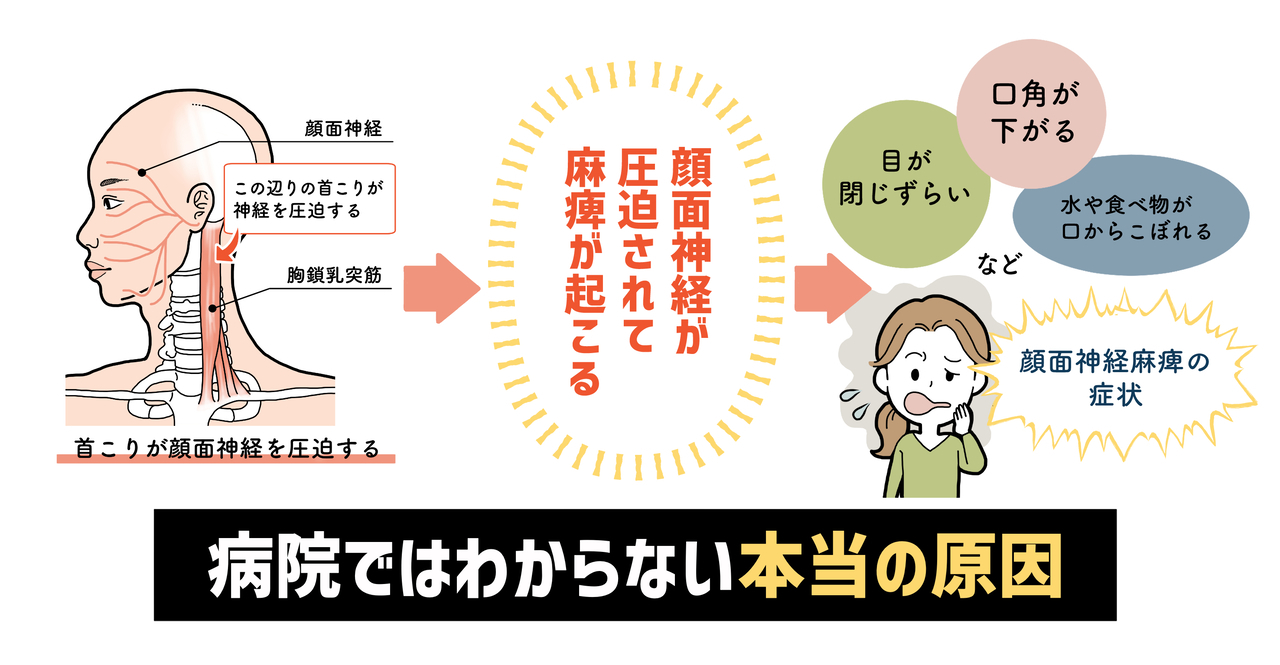病院でも治らない顔面神経麻痺の原因は 実は首コリにあります